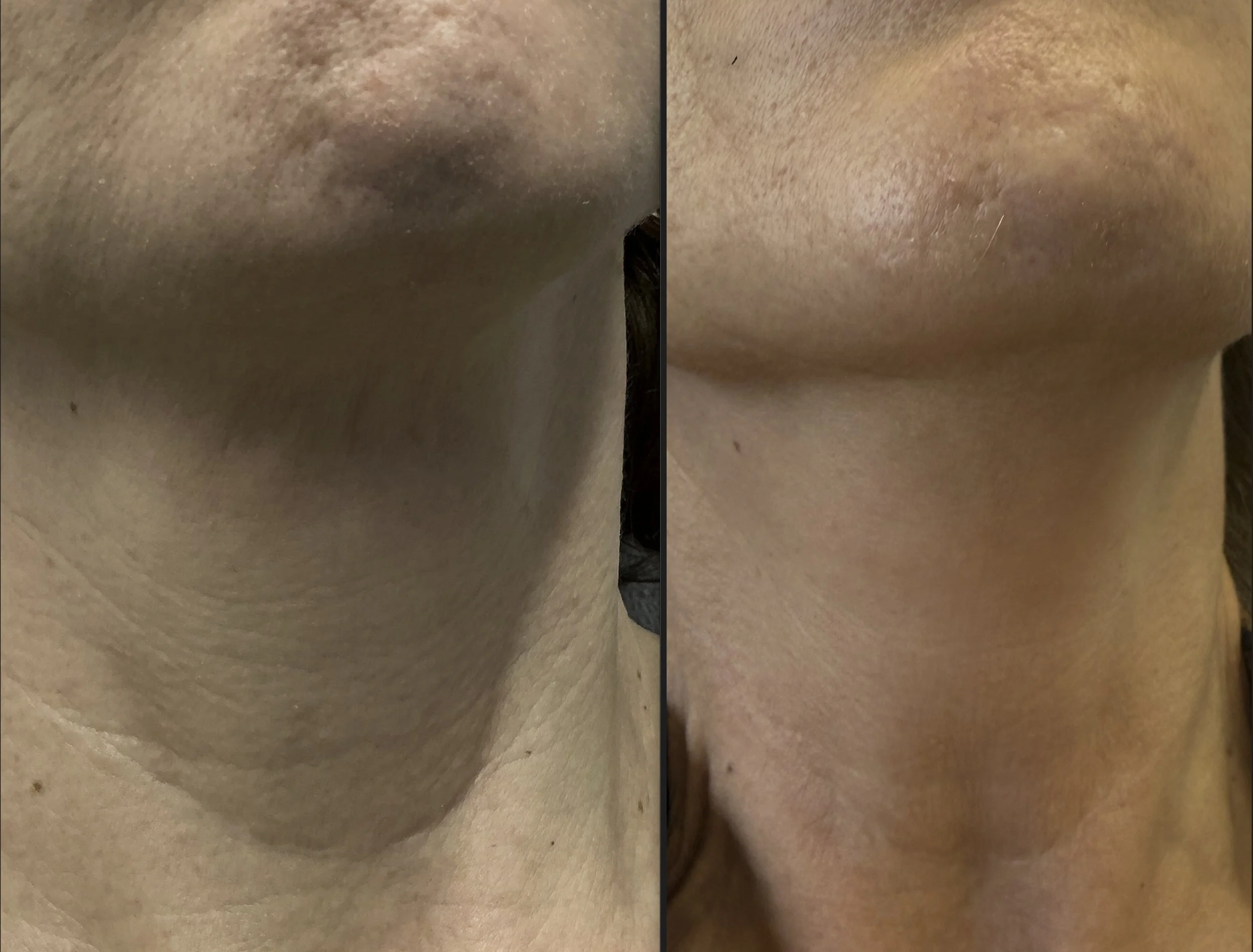 Close-up comparison of a person's neck and jawline before and after skin treatment showing improved skin texture and reduced redness.