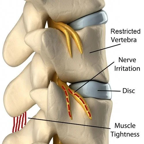 Diagram of a lumbar spine showing a herniated disc causing nerve irritation, with labels for restricted vertebra, nerve irritation, disc, and muscle tightness.