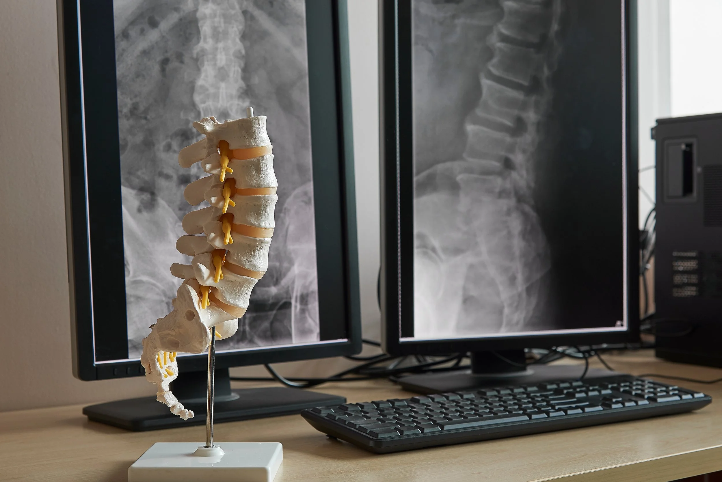 Model of a human spine with nerves, placed in front of two computer monitors displaying X-ray images of the spine on a desk.