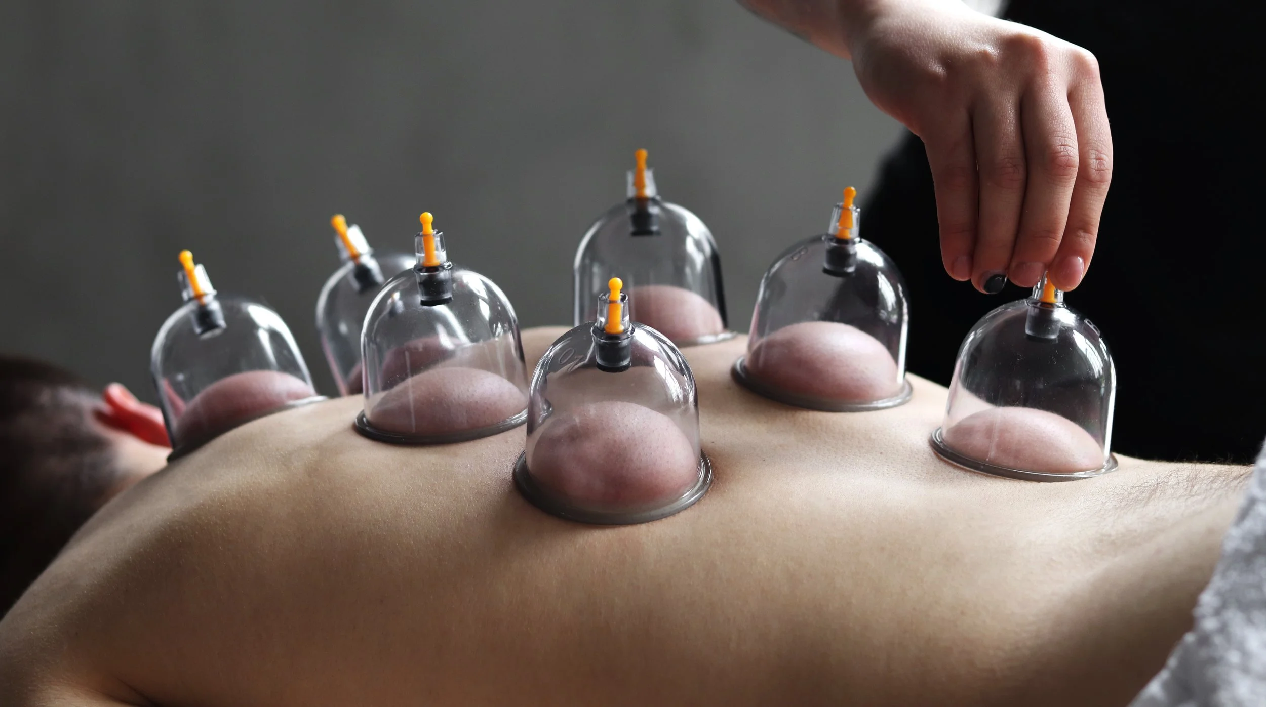 Image of Therapist utilizing Cupping therapy to reduce inflammation and pain of soft tissues. 