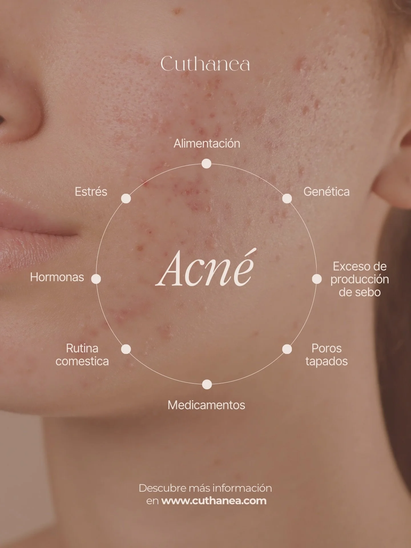 El acn&eacute; es la enfermedad de la piel m&aacute;s frecuente en el mundo, estos son algunos de los factores que pueden desencadenar o empeorar el acn&eacute;. 

✴︎ Exprimir los granitos puede aumentar el riesgo de manchas y cicatrices permanentes.