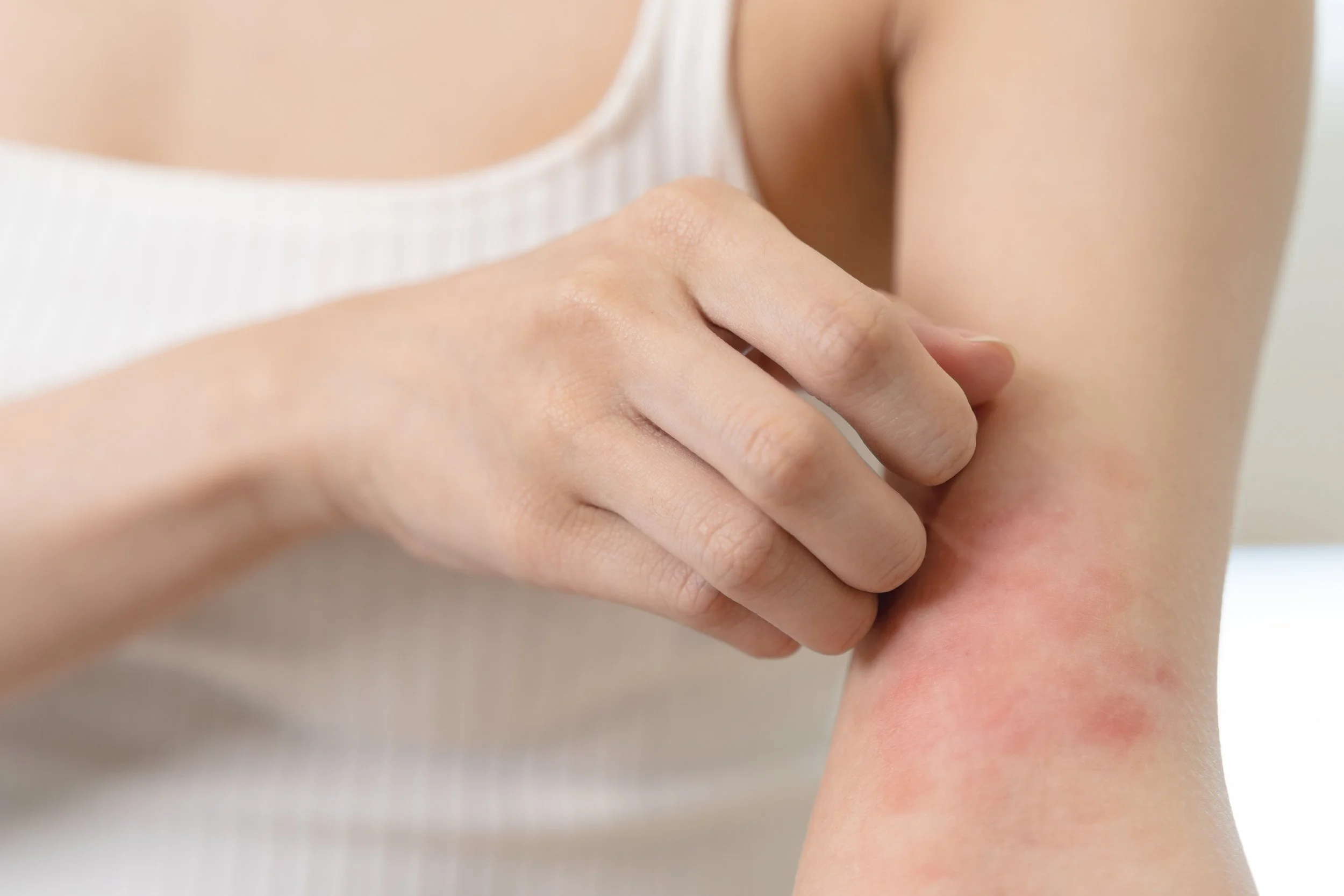 Rash por calor: qué es, por qué aparece y cómo tratarlo
