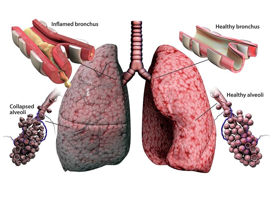 How to Prevent COPD: Practical Actions to Protect Your Lungs Starting Today