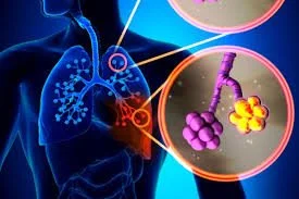 Lung Cancer and Breathing: Why Pulmonary Function Matters