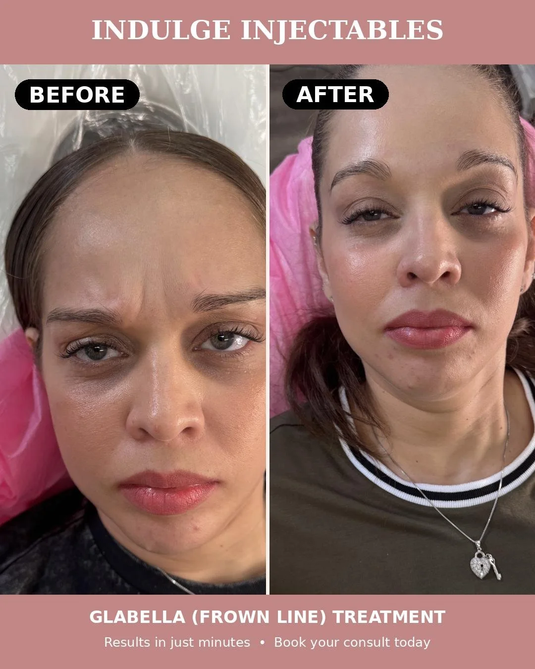 Glabella Treatment