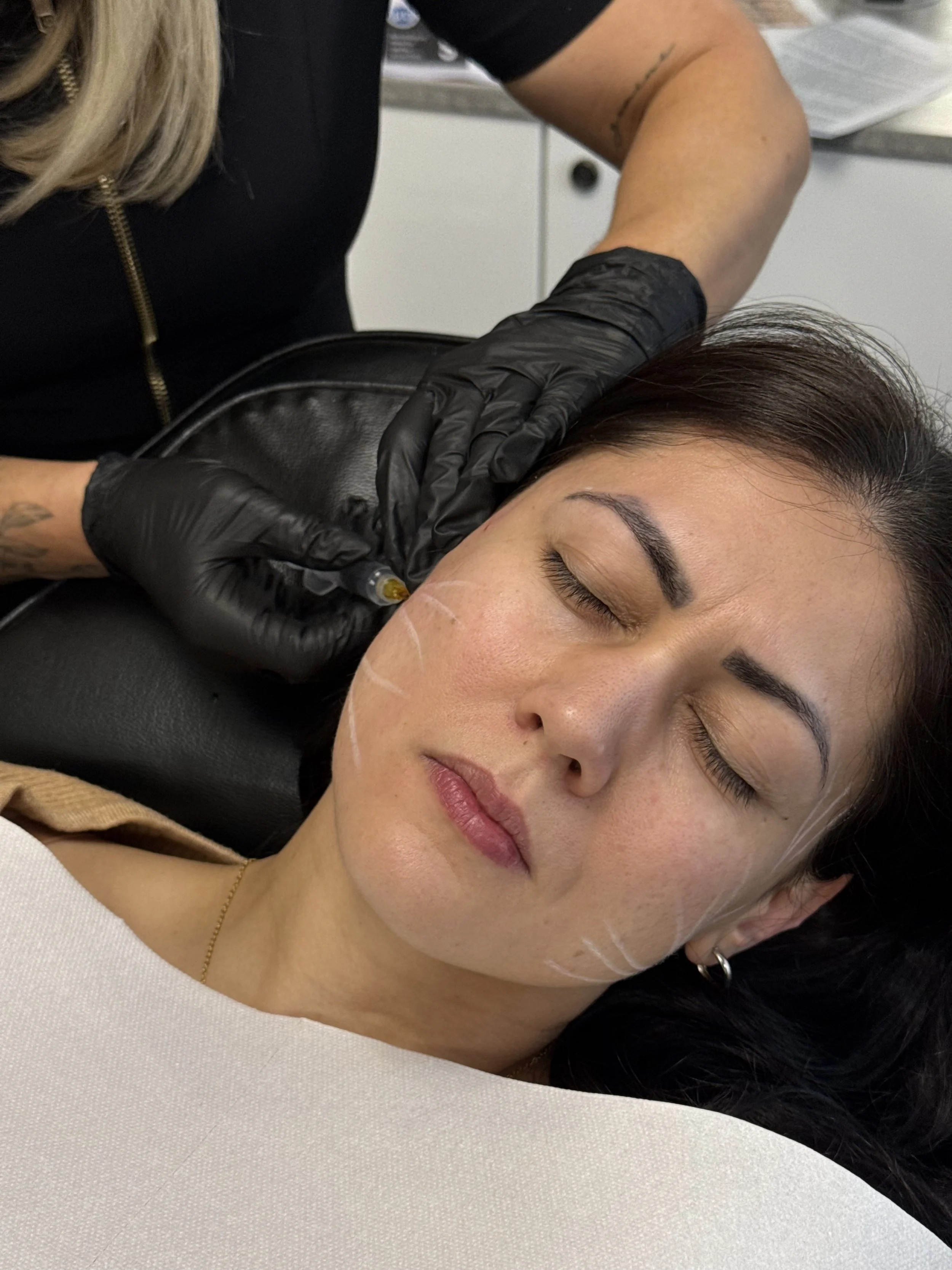 A woman with dark hair lying down with her eyes closed, receiving a cosmetic injection in her forehead from a professional wearing black gloves. The professional's arm and part of their torso are visible.