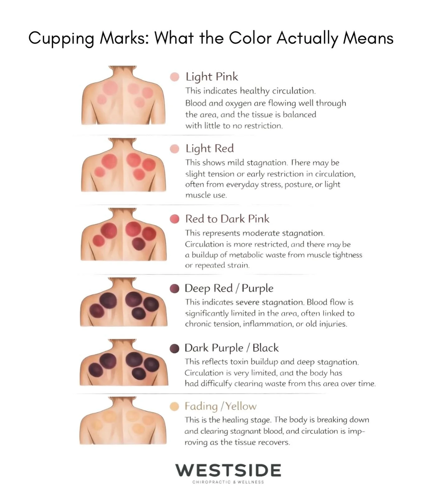 Cupping therapy isn&rsquo;t an add-on here&mdash;it&rsquo;s part of our standard.

At Westside, our massage sessions are designed to actually do something for your body.
Not just relax you&hellip; but restore you, fix you!

Cupping therapy helps:
&bu