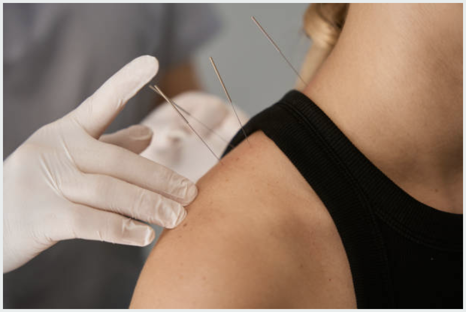 A person receiving acupuncture treatment on their shoulder with thin needles inserted into their skin.