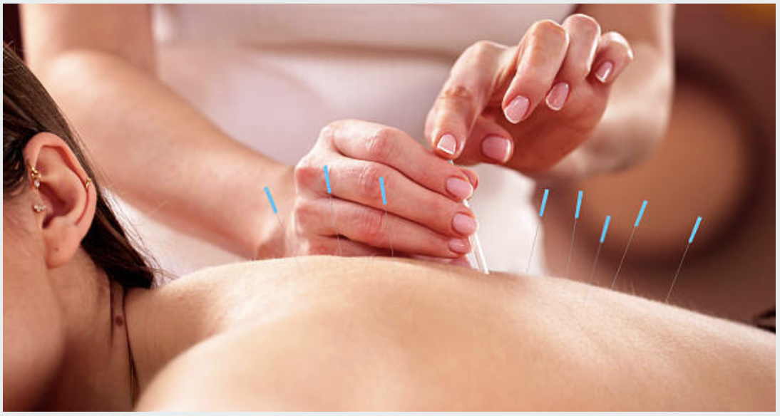 Person receiving acupuncture treatment on their back with thin needles inserted into skin.