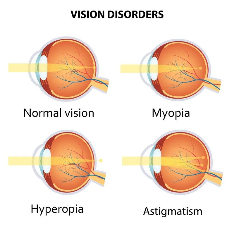 Diagram showing different vision disorders in the eye, including normal vision, myopia, hyperopia, and astigmatism.