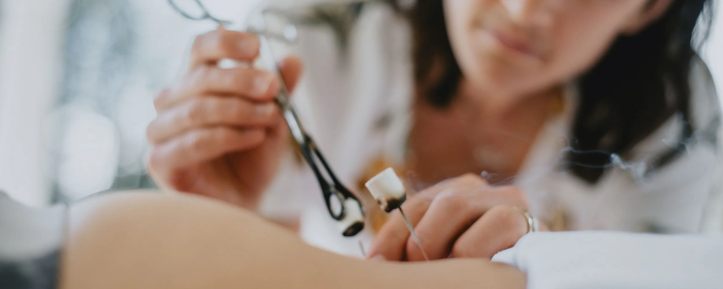How Acupuncture Supports Fertility—Naturally and Holistically