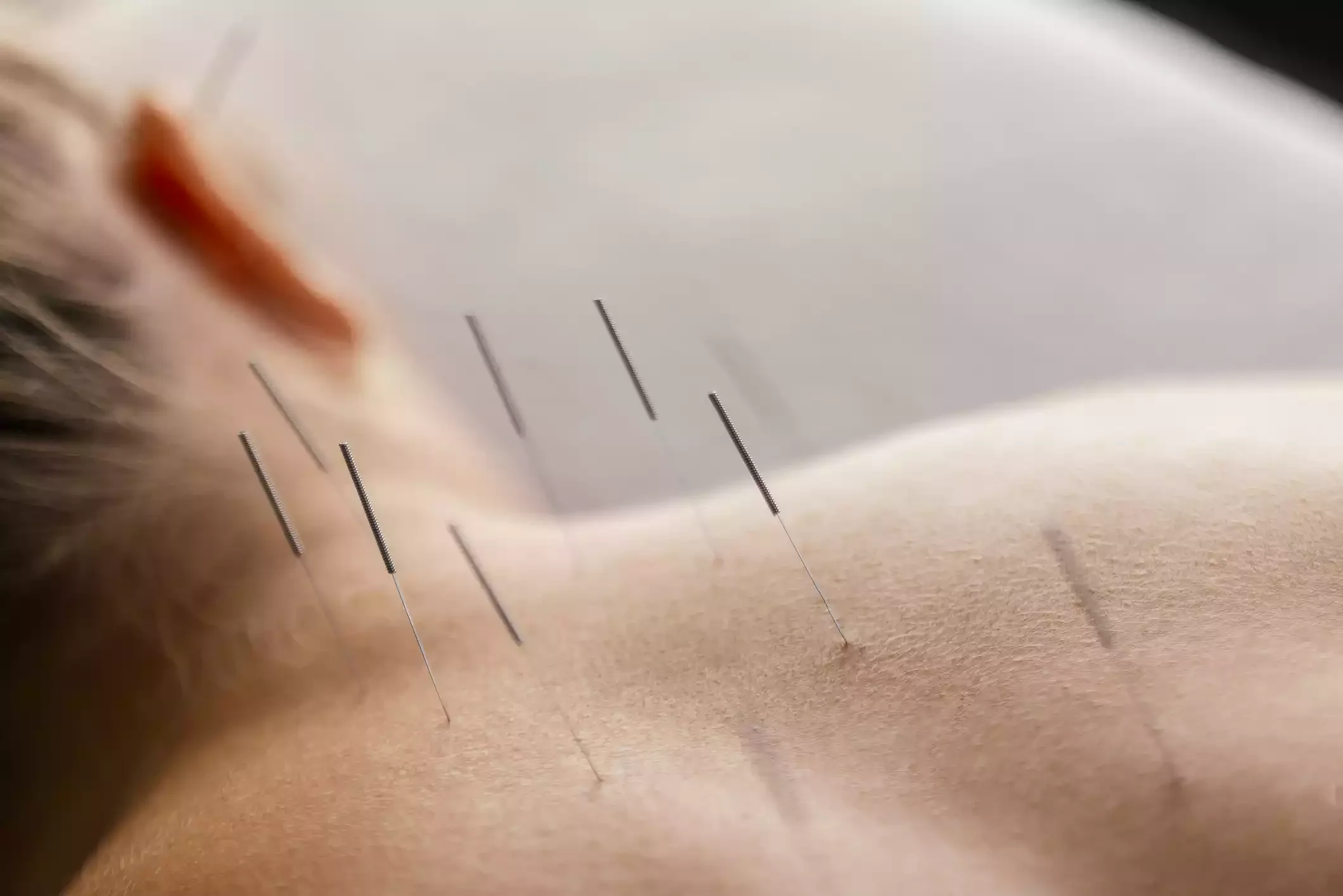 Doctor of Osteopathic Medicine performing medical acupuncture treatment.