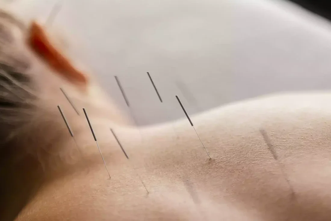 How Medical Acupuncture Supports Whole-Body Healing