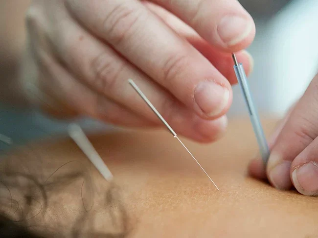 Medical Acupuncture Worthington Ohio