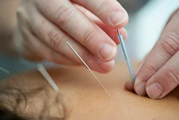 Medical Acupuncture