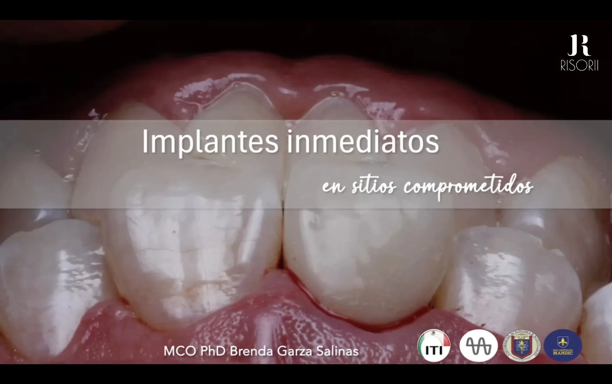 Implantes Immediatos en Sitios Comprometidos ft. Dra. Brenda Garza