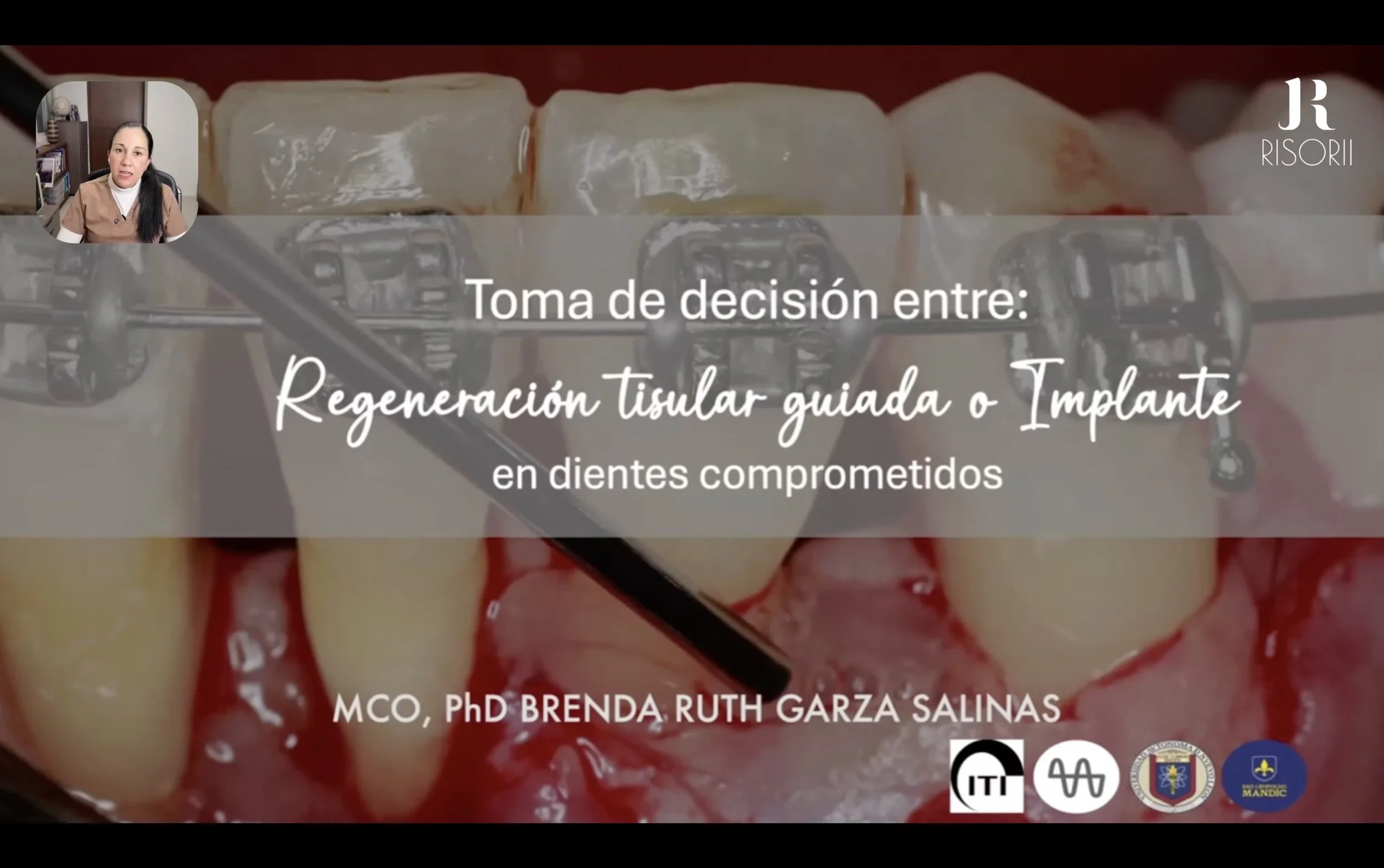 Regeneración Tisular Guiada o Implante en Dientes Comprometidos ft. Dra. Brenda Garza
