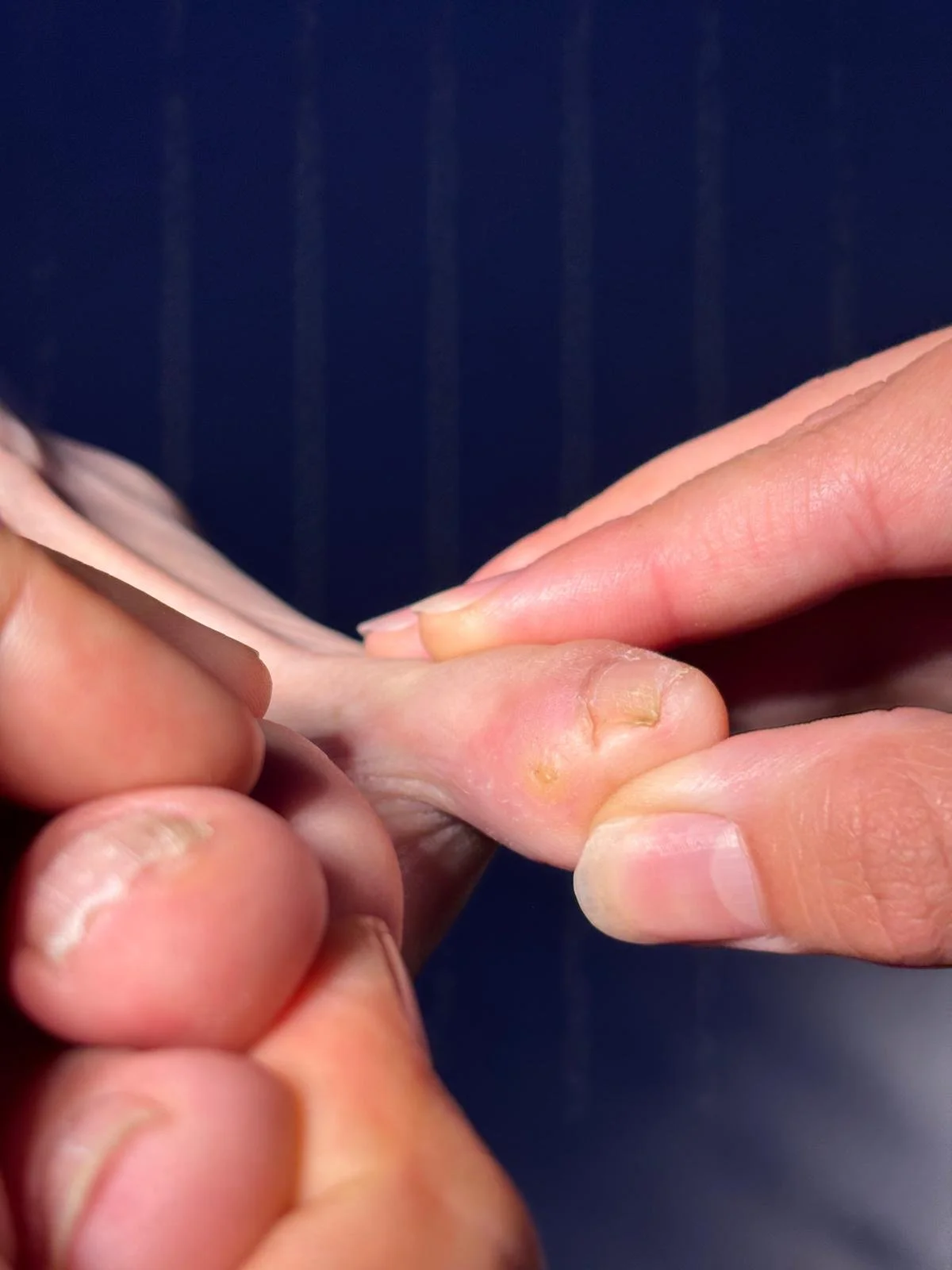 Heloma Interdigital: Por qué los "callos" entre los dedos suelen ser un problema de hueso