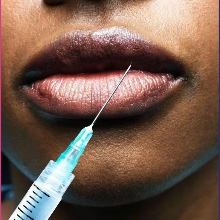 Lip filler treatment for enhancing lip fullness and definition, providing natural and beautiful results tailored to individual features.