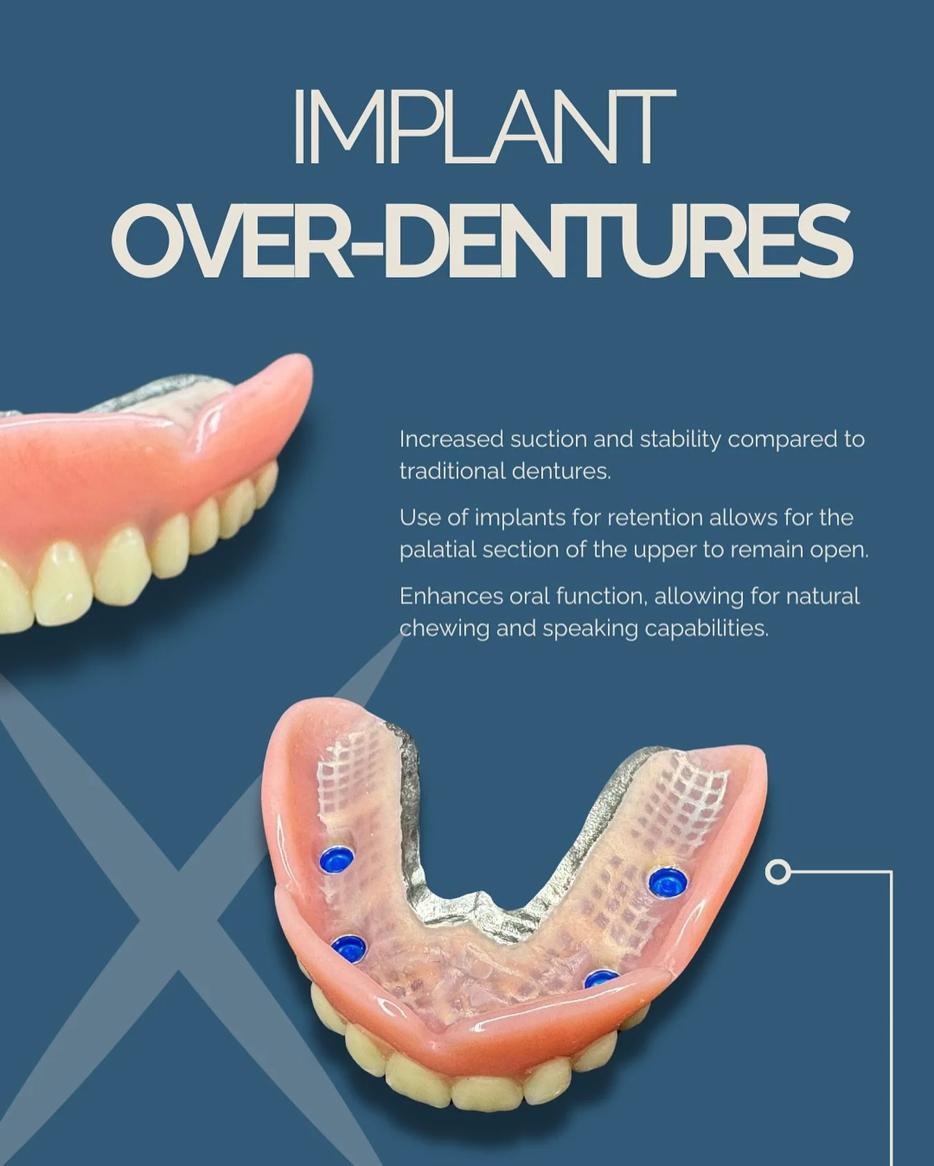 Implant-supported dentures are a reliable solution for patients who want the stability of implants with the convenience of a removable prosthesis. 🦷✨

By attaching to strategically placed implants, these dentures provide retention and security beyon