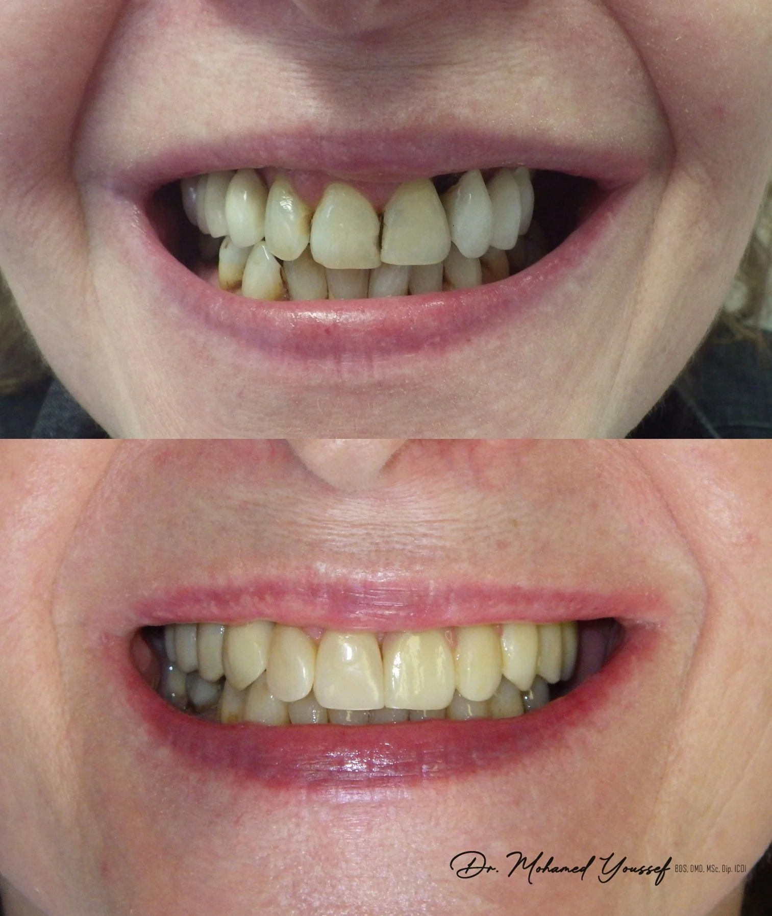 Before and after dental implants montreal treatment