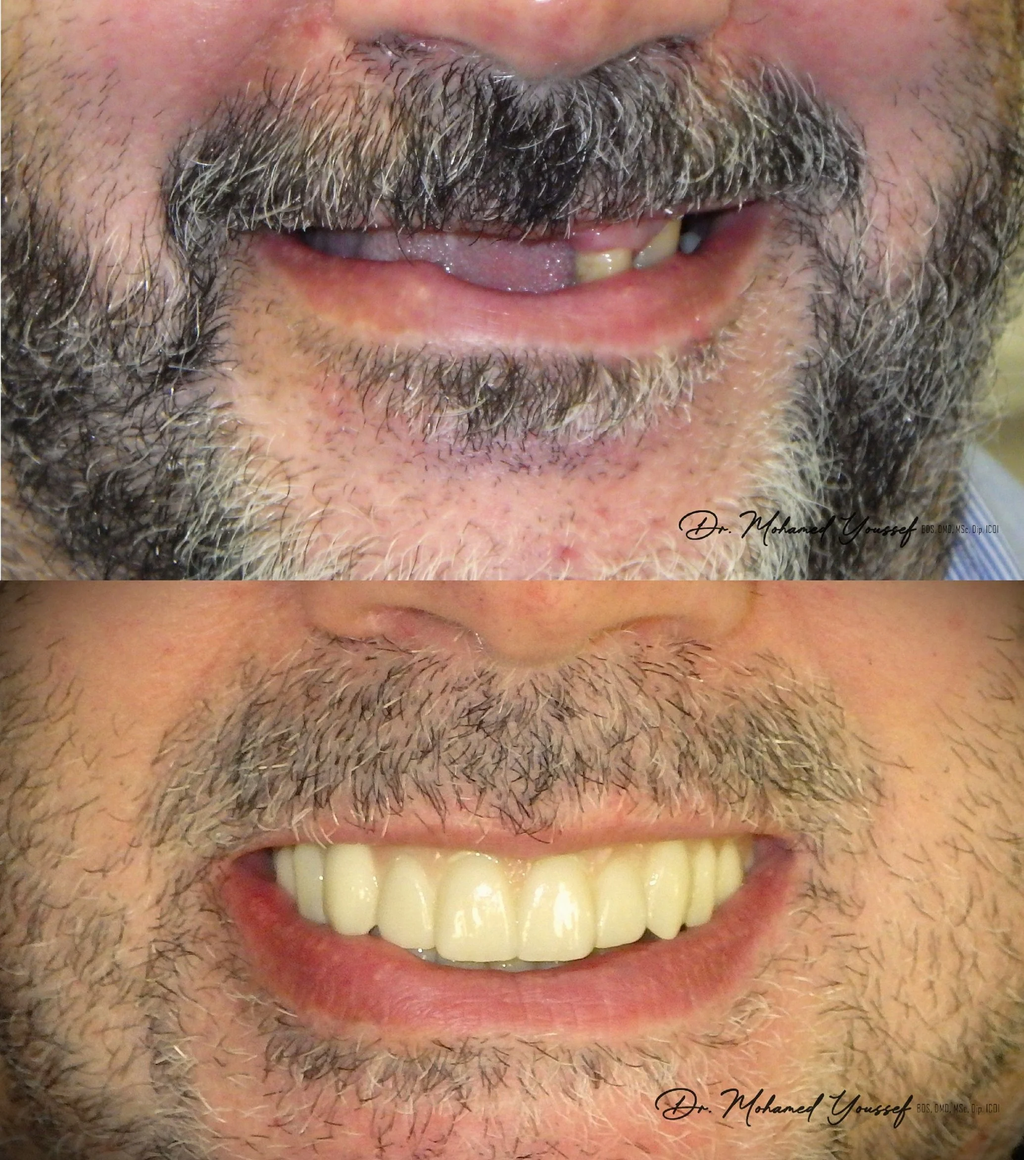 Comparison of a man's mouth before and after dental treatment, showing improved teeth and smile.
