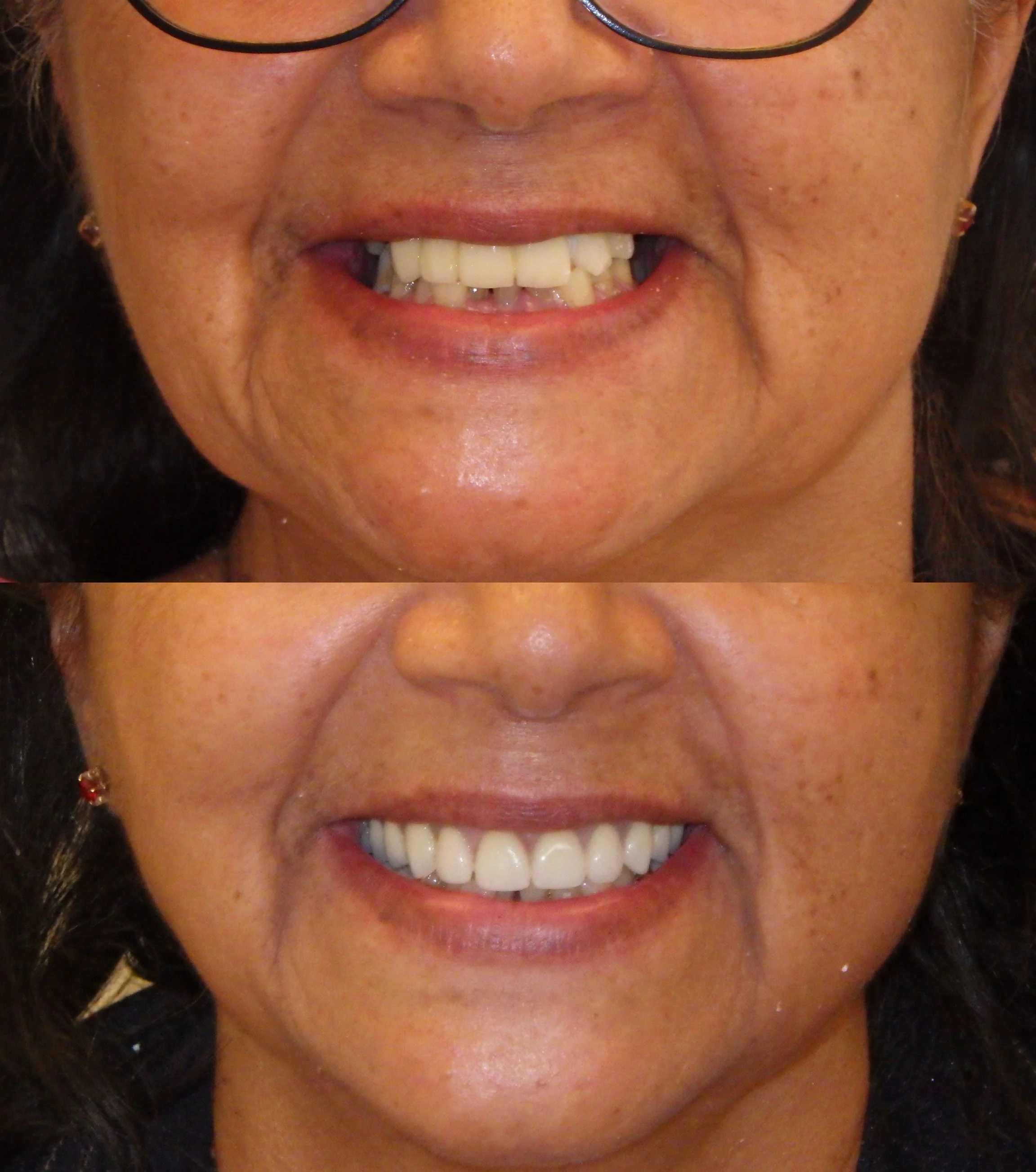 Comparison of a woman's teeth before and after dental work, showing improved and whiter teeth in the lower image.