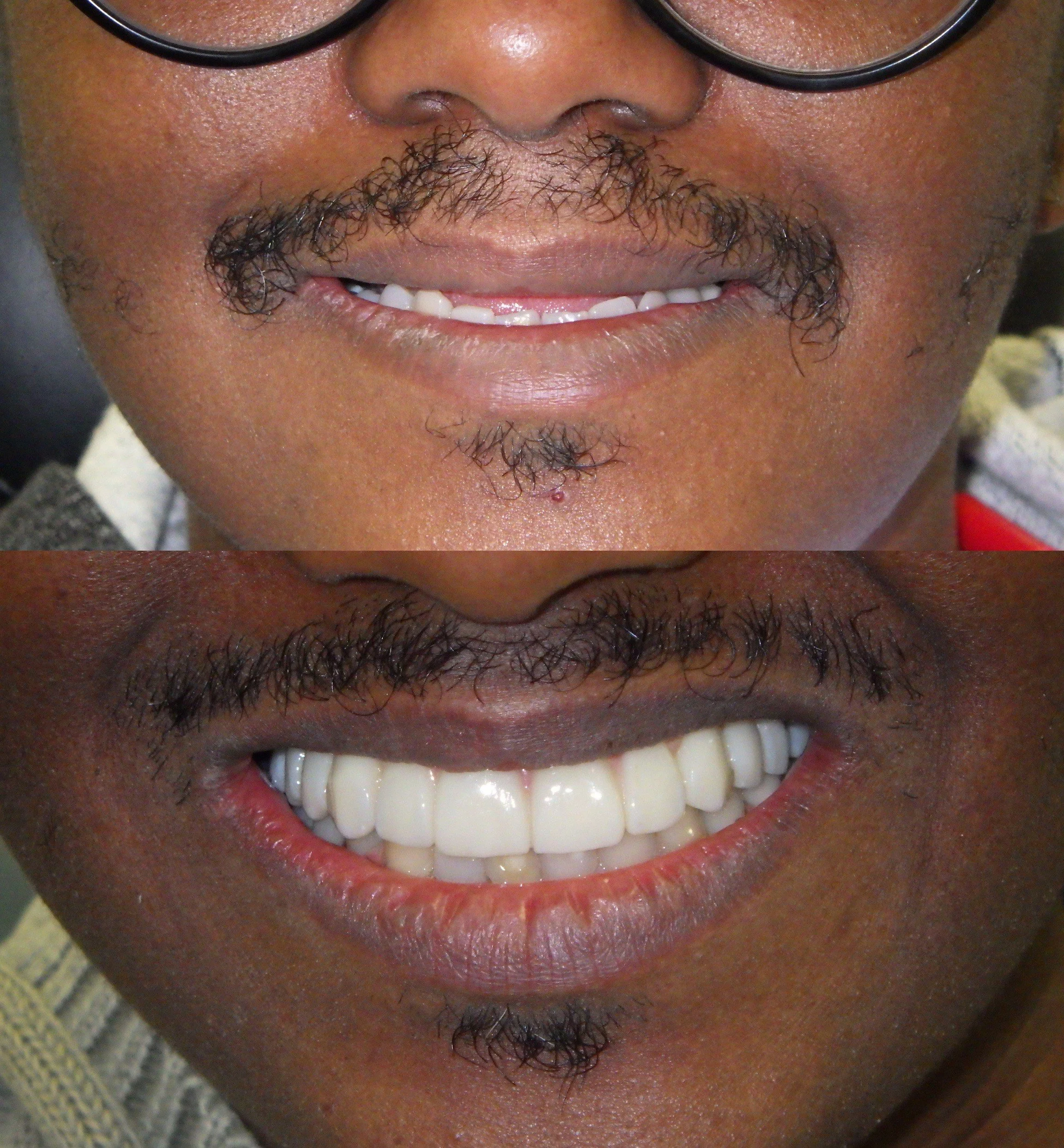 A before-and-after comparison of a person's smile, showing improved dental appearance with new, white dental veneers or crowns.