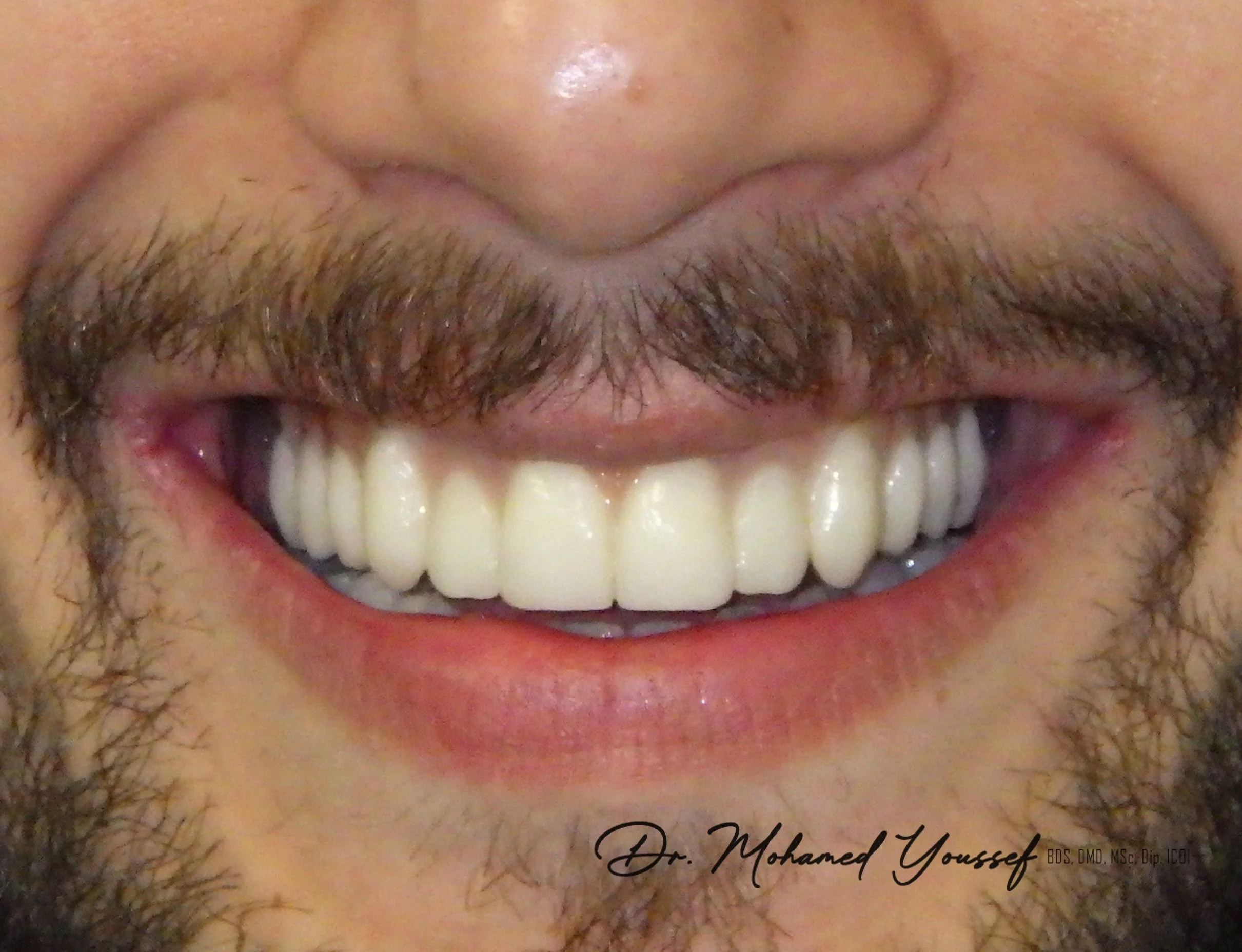 Close-up of a smiling man's face showing teeth with a white dental veneer or crown, mustache, and beard, with a visible dimples in his cheeks.