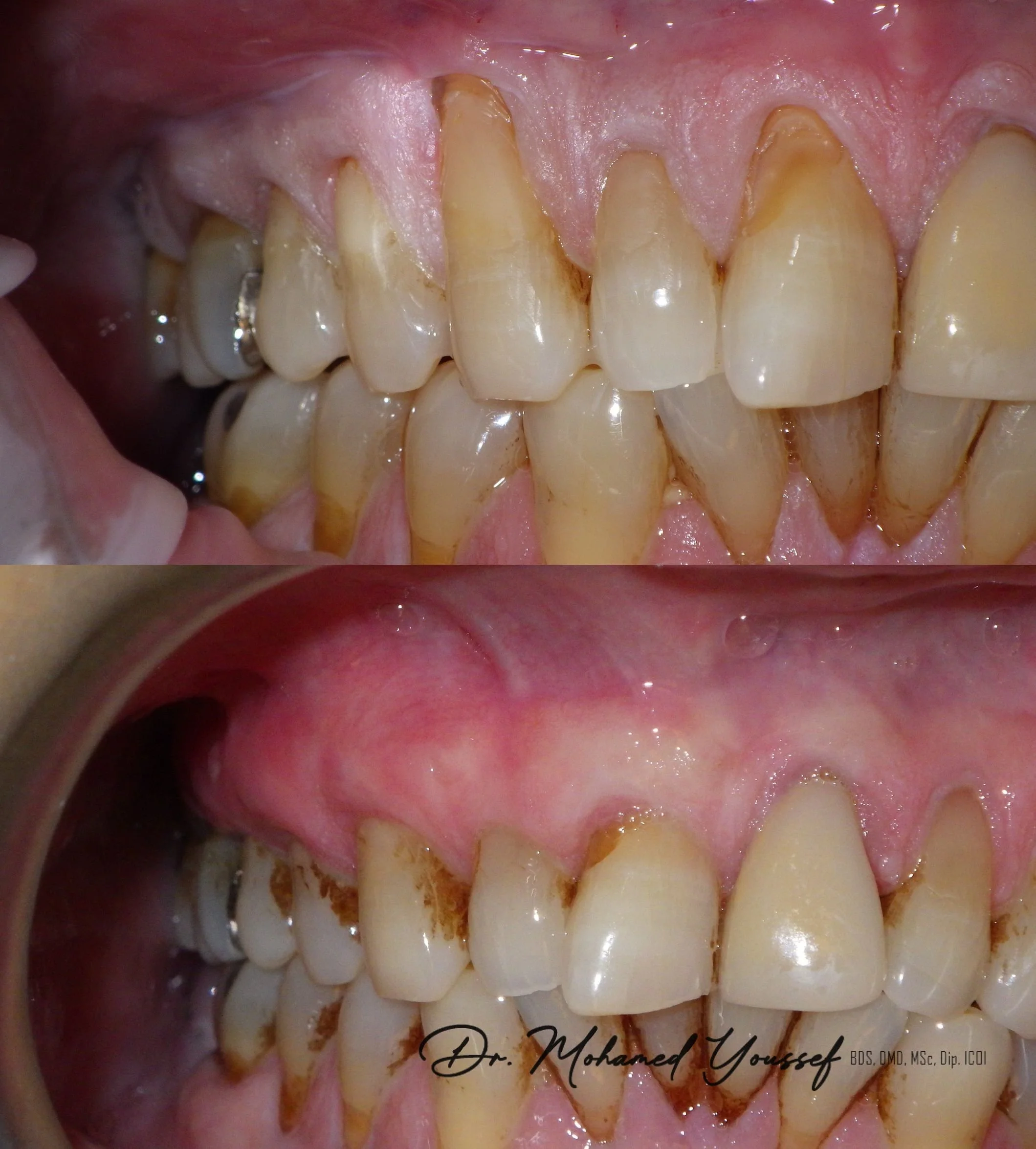 Close-up of teeth before and after dental cleaning, showing plaque removal and improved oral health.