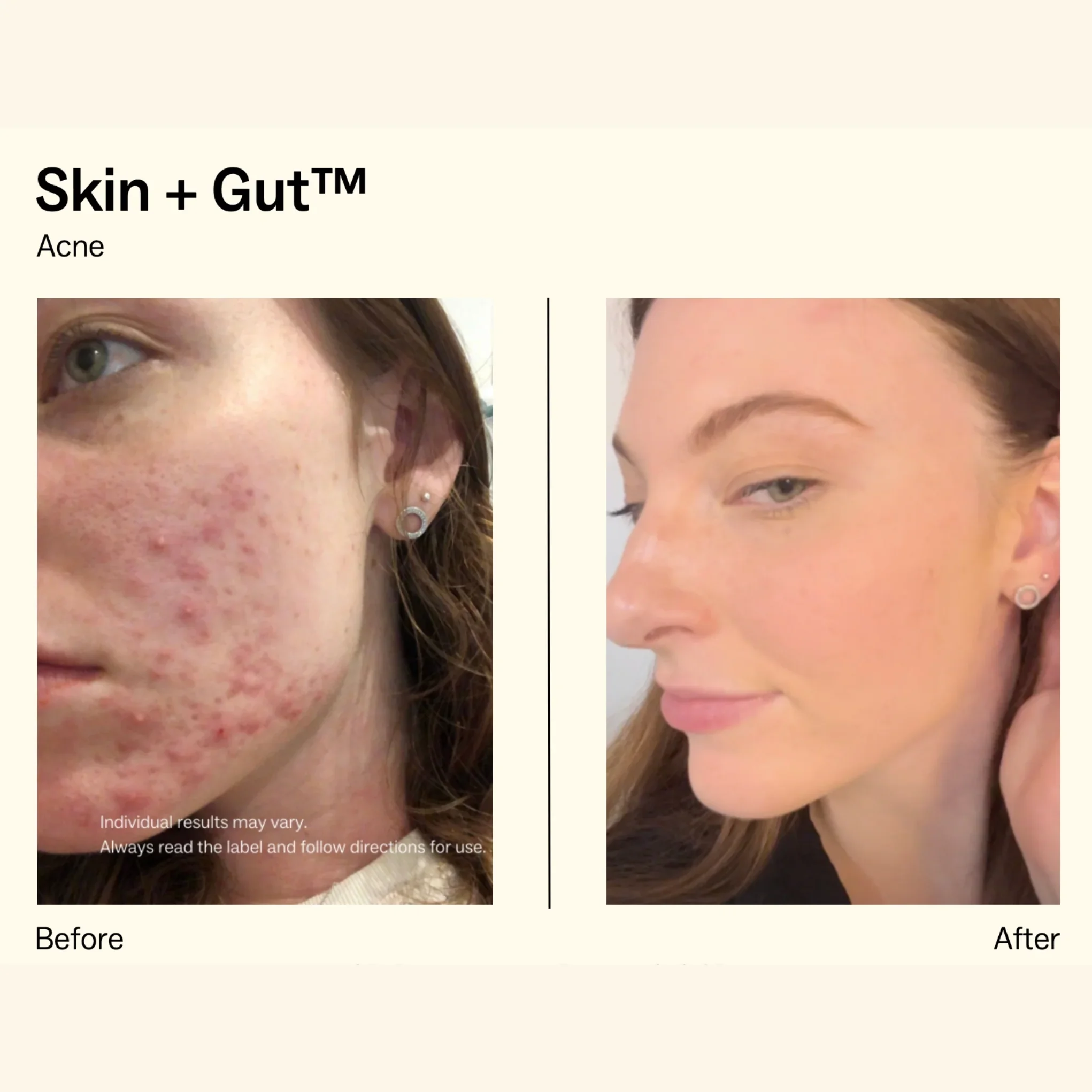 Skin + Gut Capsules Before & After Acne Image