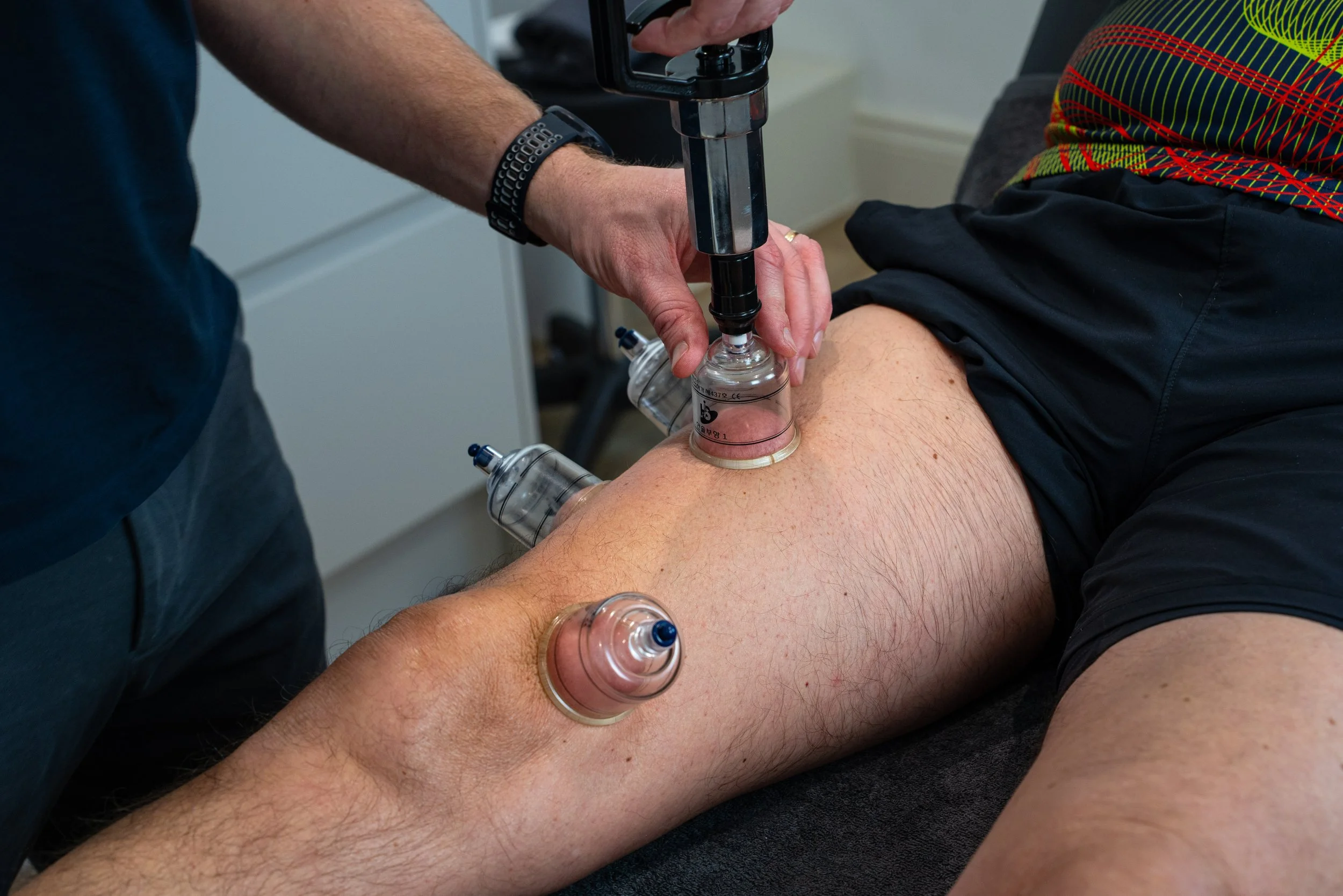 A person receiving cupping therapy on their thigh, with multiple glass cups and a suction device applied.