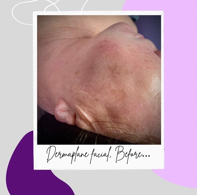 Look at this before &amp; after of a Dermaplane Facial&hellip; just WOW!✨💜
#healthyskin #glowingskin #skinhealth #glowingskincare #luxurybrand #luxury #clearskin #antiageingskincare #antiaging #antiagingproducts #nonsurgicalfacelift #nonsurgicaltrea