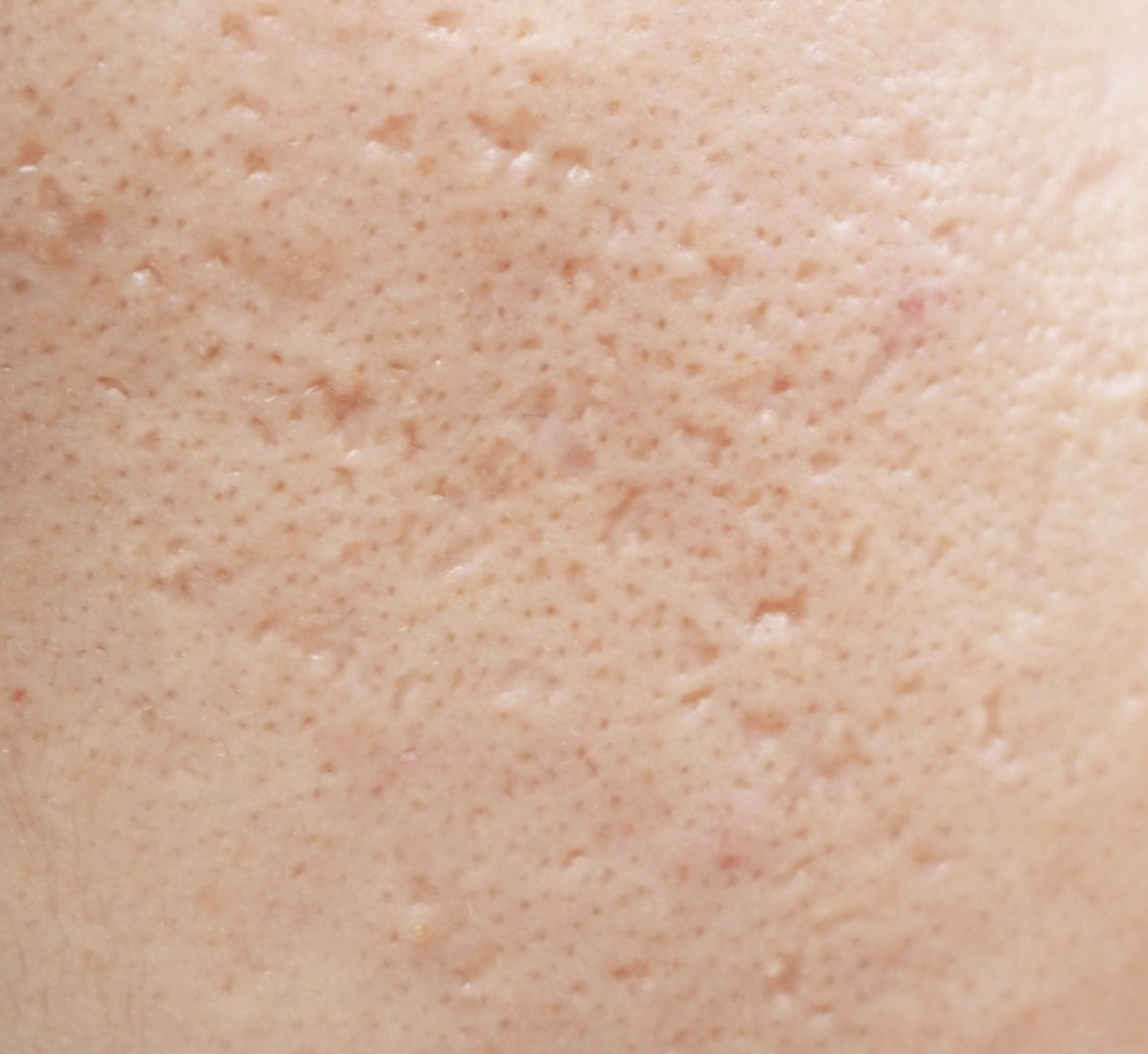 Cicatrices d’acné : comprendre et traiter grâce au laser fractionné non ablatif