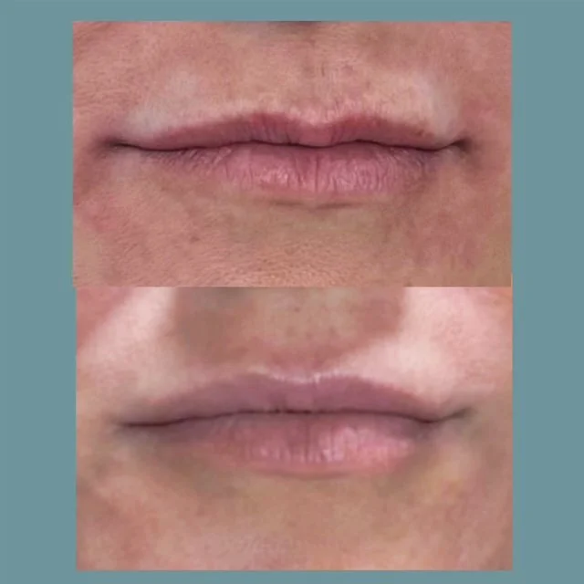 Perioral Filler