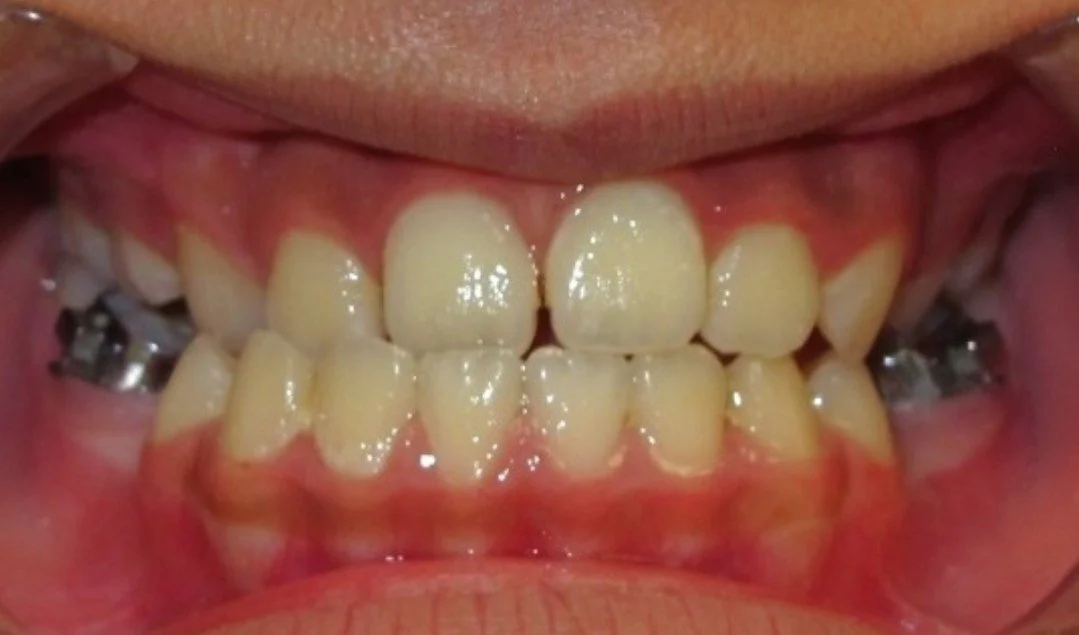 Before treatment