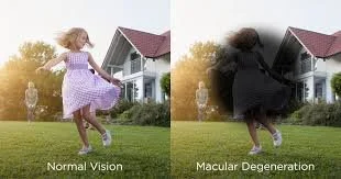 before and after Split view of macular degeneration
