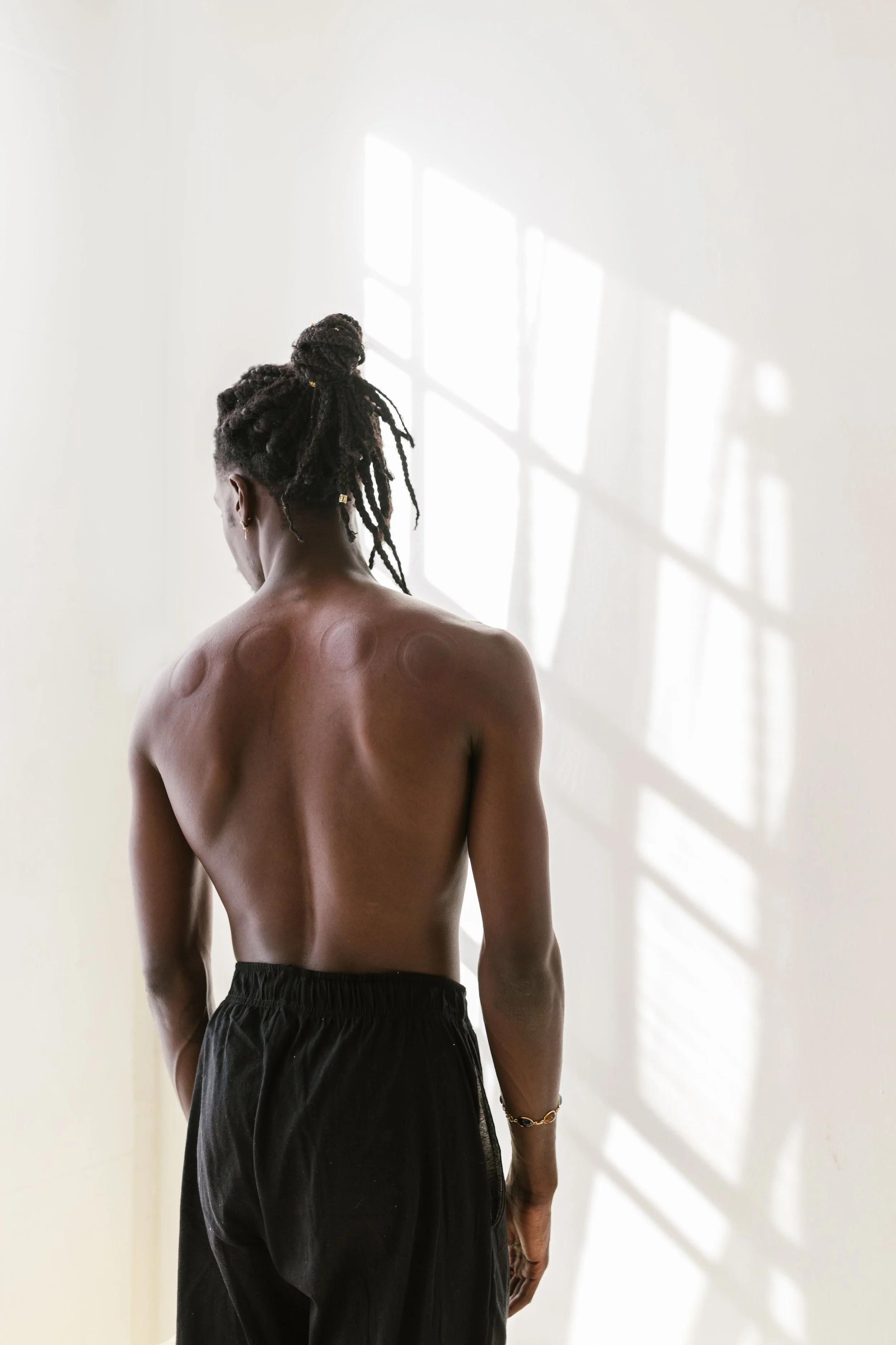 Man's back with cupping marks