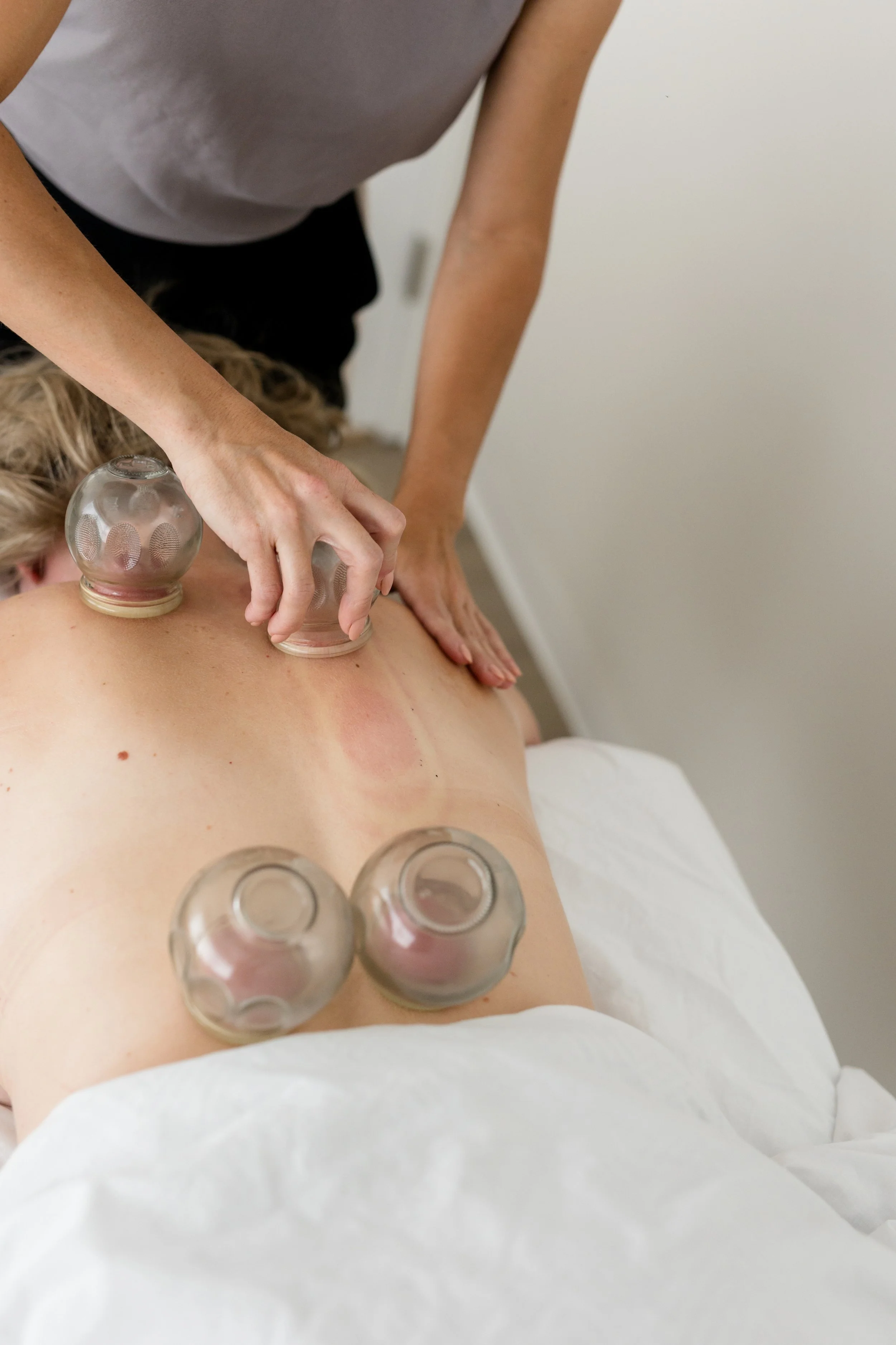 Drift Acupuncture - Traditional Chinese Medicine, Cupping