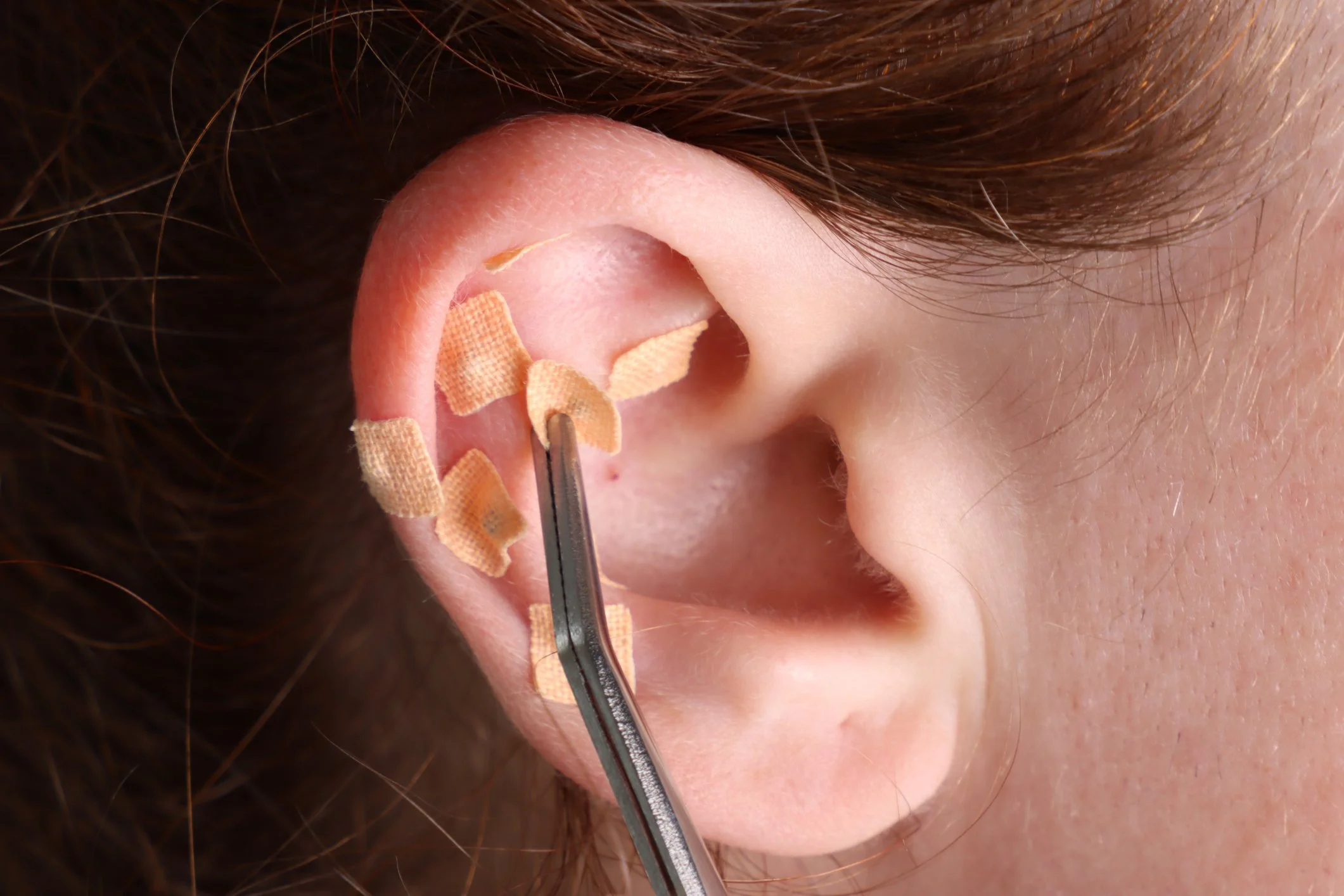 Close up photo of a woman's ear with ear seeds applied to acupuncture points and the practitioner's tool placing the ear seed