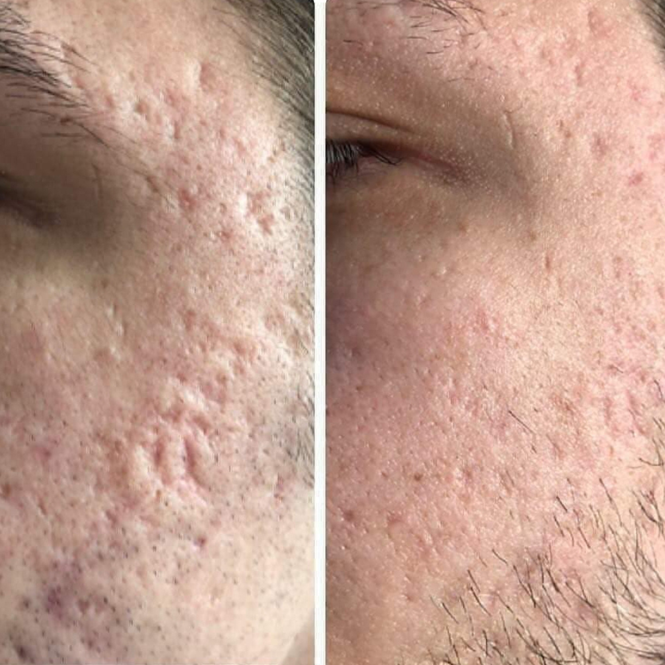 Close-up of a person's face showing improvement in acne scars and skin texture, before and after skincare treatment.