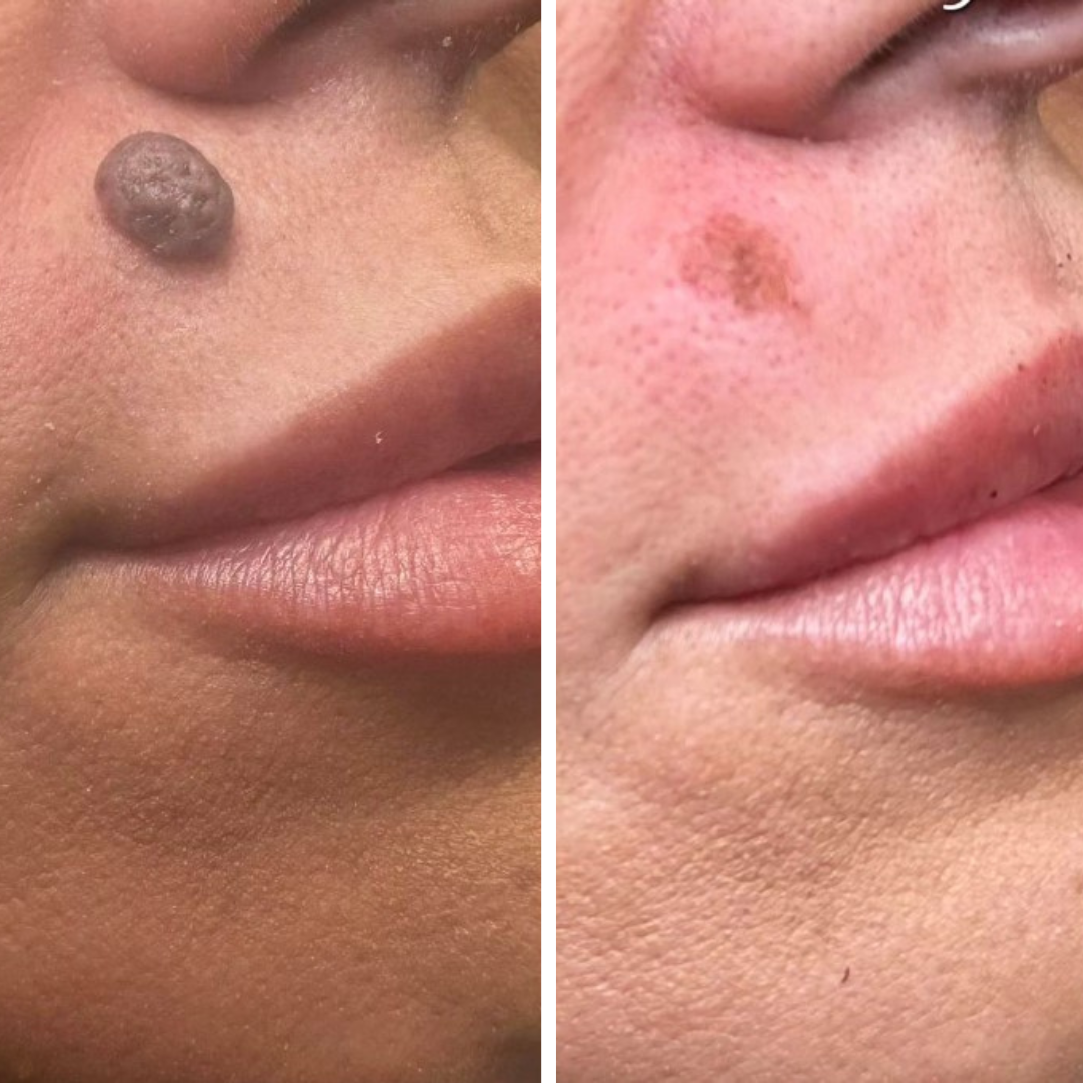 Mole Removal.png