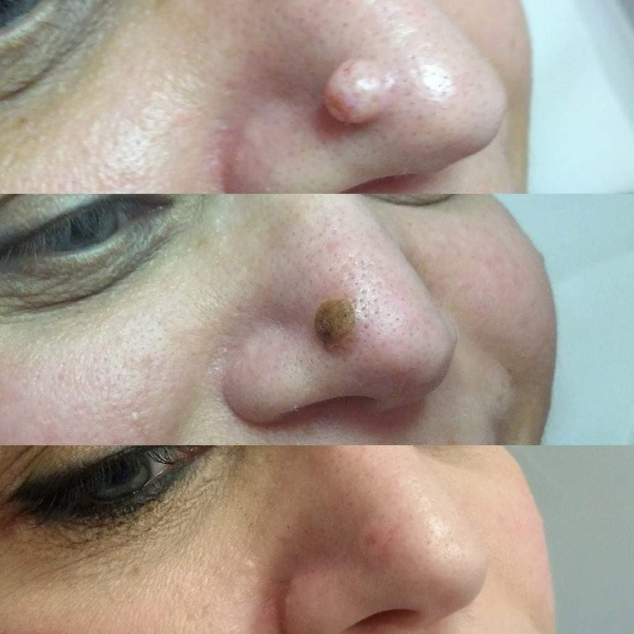 Cyst Removal.png