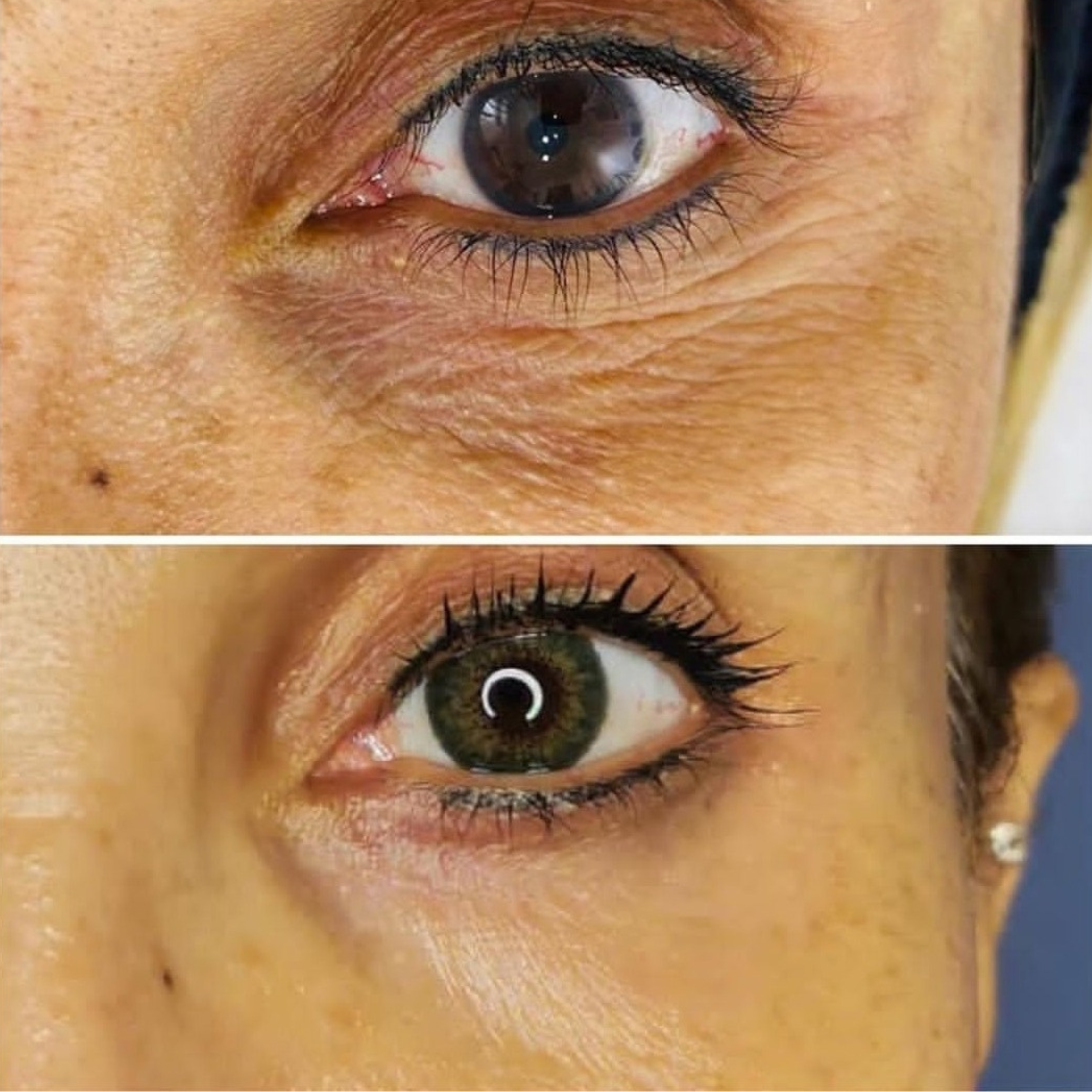 Bhlepharoplasty.png