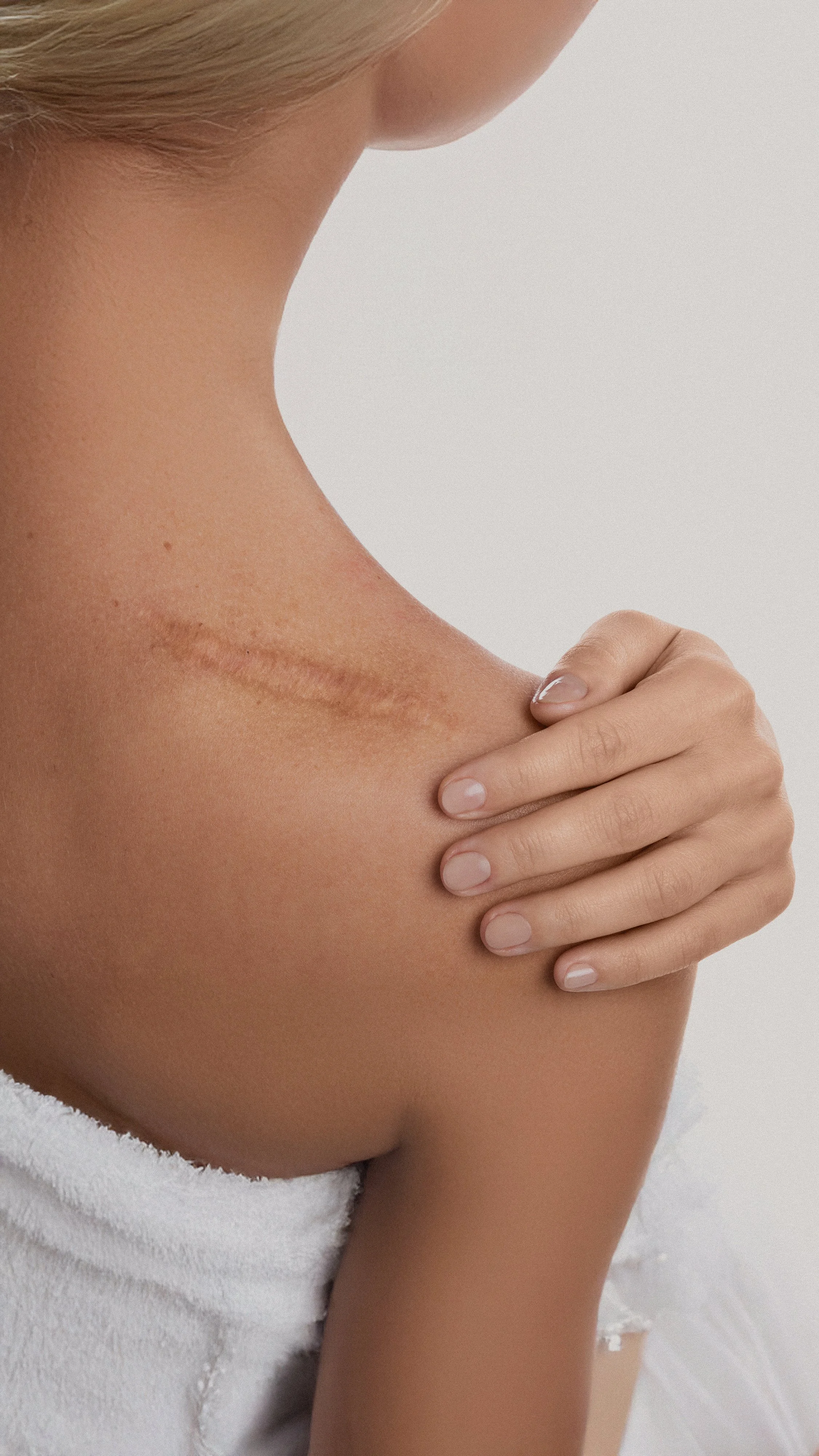A woman with a visible, fresh scar on her upper arm, holding her arm with her other hand, against a plain background.