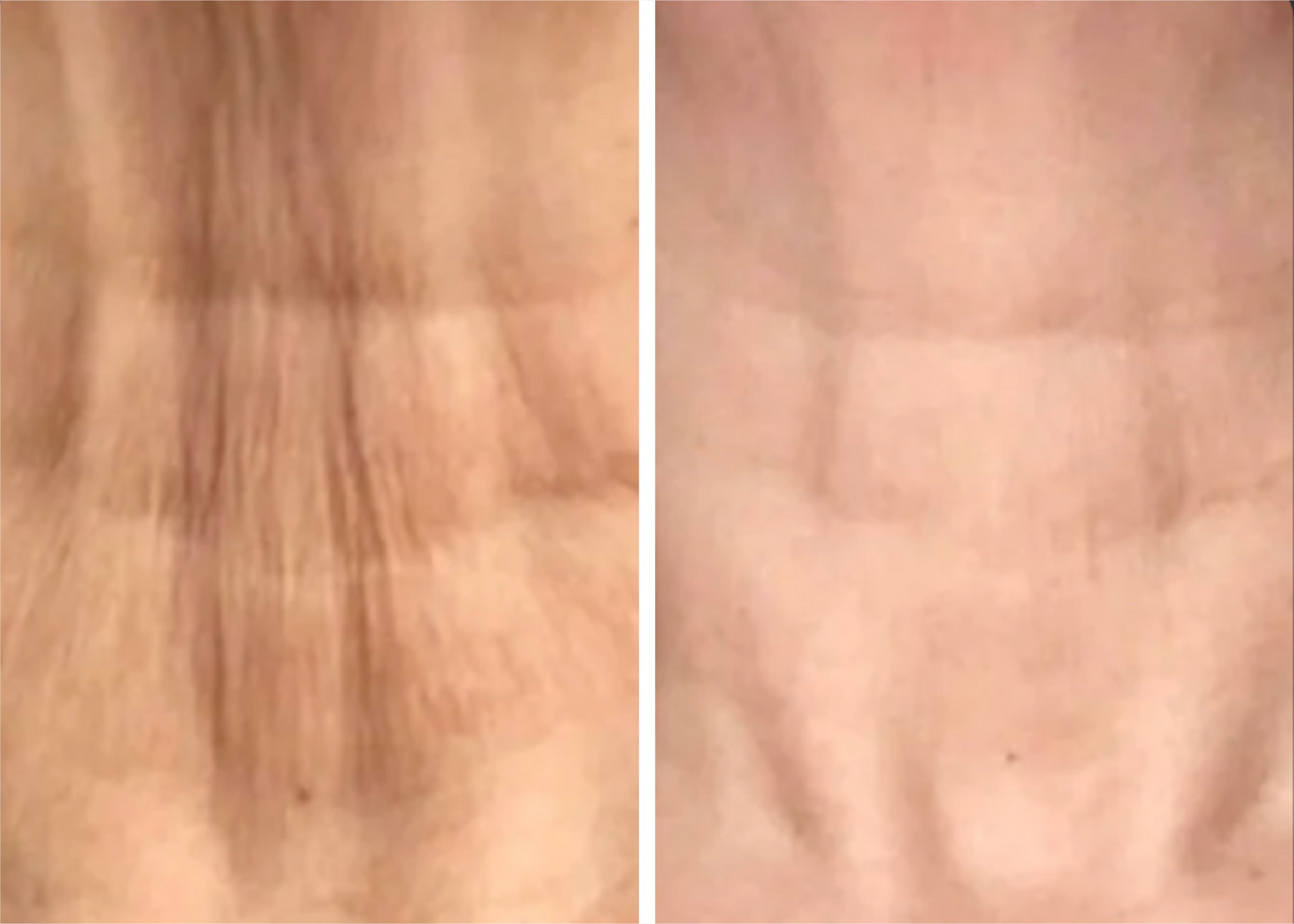 Close-up of a person's forehead showing significant forehead wrinkles before and after reduction or treatment.