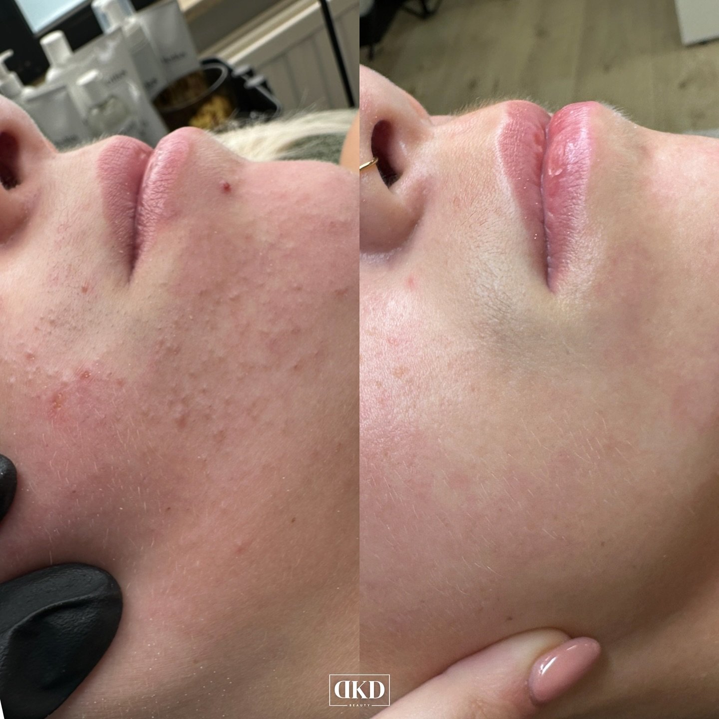 Deze huid had last van onzuiverheden, structuur en roodheid. Met een combinatie van de Clarity Facial en consequent gebruik van de geadviseerde Medik8 producten, zie je hier al een groot verschil! 🤩

Consistentie = key! Wil jij ook werken aan een zu