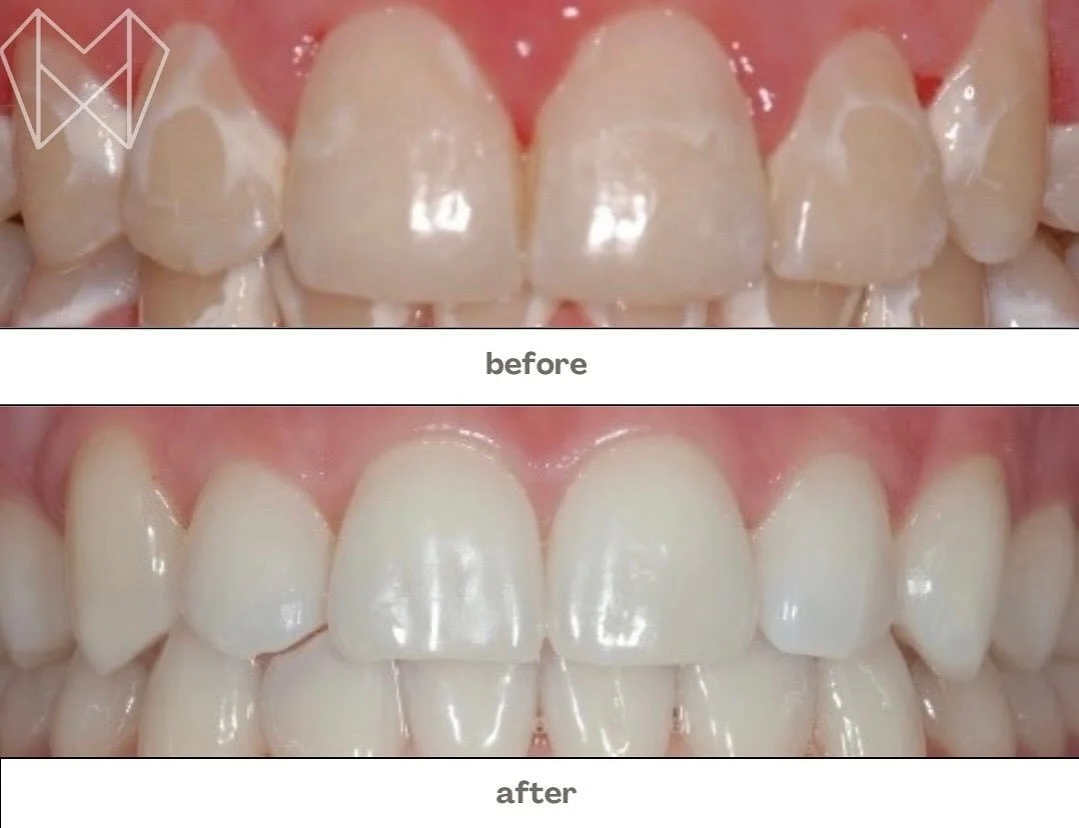 Happy Wednesday! 🌟 A little fluoride goes a long way in protecting and strengthening your smile. ✨ Healthier teeth, brighter results, and lasting protection 🦷💙 #FluorideBenefits #SmileStrong