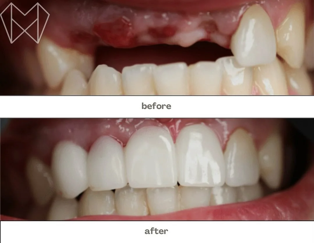 ✨ Smile Transformation Alert! ✨
From missing teeth to a flawless smile dental implants made all the difference. 💎🦷
Ready to regain your confidence and love your smile again? We&rsquo;re here to help!
📞 Call Northland Dental at 519-455-2551 to book
