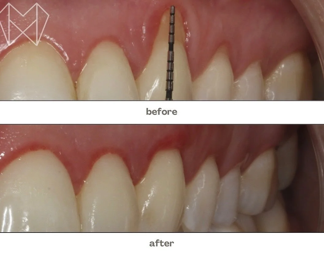 Healthy gums, healthy smile! ✨
From recession to restoration &mdash; see the difference expert care makes. 🦷💗 #GumHealth #SmileTransformation #BeforeAndAfter
